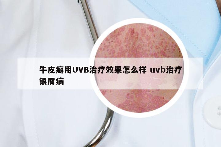 牛皮癣用UVB治疗效果怎么样 uvb治疗银屑病