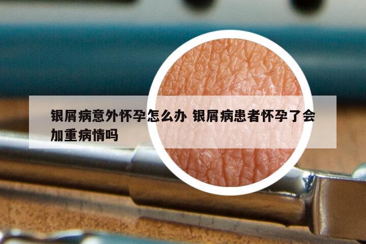 银屑病意外怀孕怎么办 银屑病患者怀孕了会加重病情吗