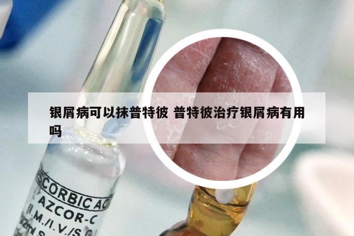 银屑病可以抹普特彼 普特彼治疗银屑病有用吗