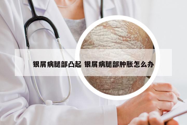 银屑病腿部凸起 银屑病腿部肿胀怎么办