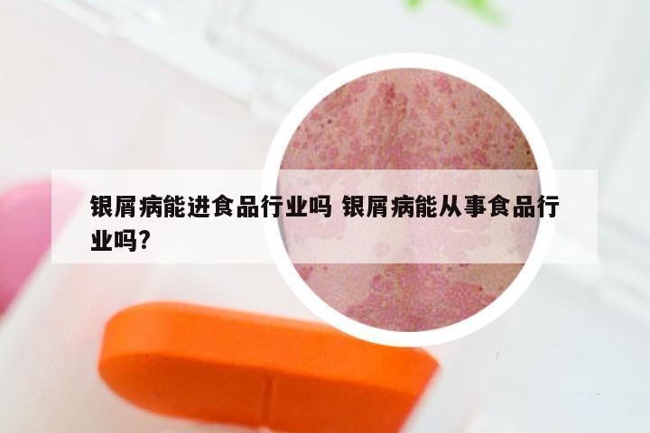 银屑病能进食品行业吗 银屑病能从事食品行业吗?