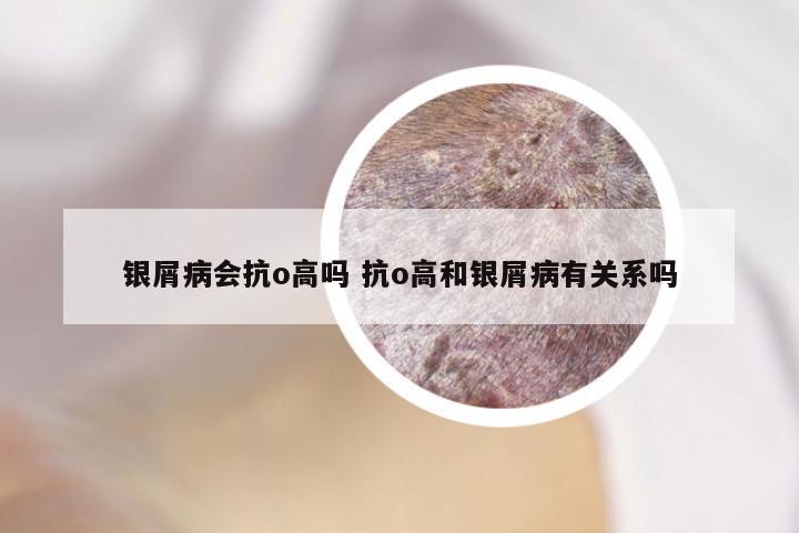 银屑病会抗o高吗 抗o高和银屑病有关系吗