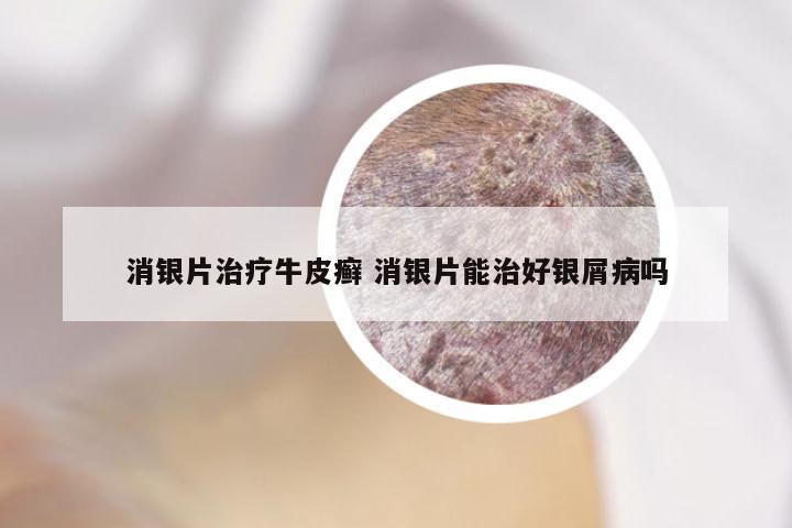 消银片治疗牛皮癣 消银片能治好银屑病吗