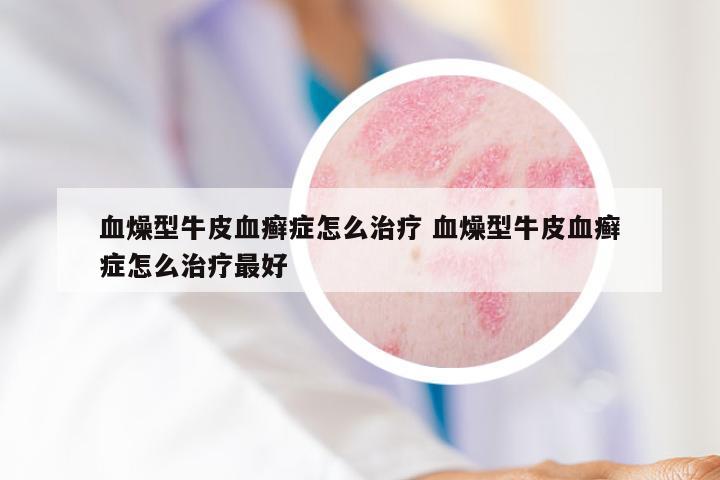 血燥型牛皮血癣症怎么治疗 血燥型牛皮血癣症怎么治疗最好