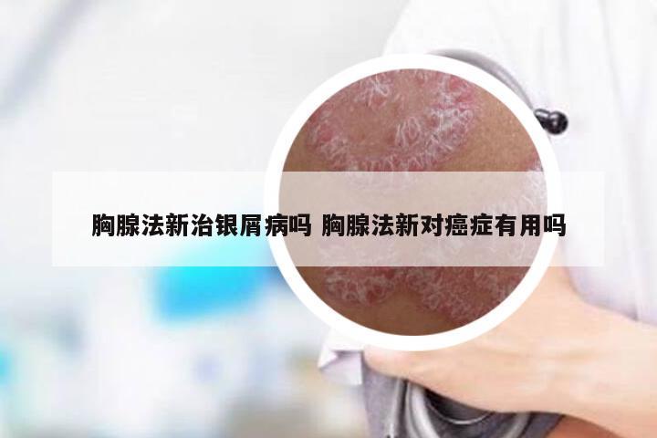 胸腺法新治银屑病吗 胸腺法新对癌症有用吗