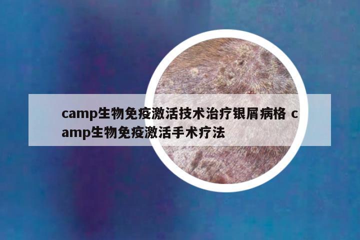 camp生物免疫激活技术治疗银屑病格 camp生物免疫激活手术疗法