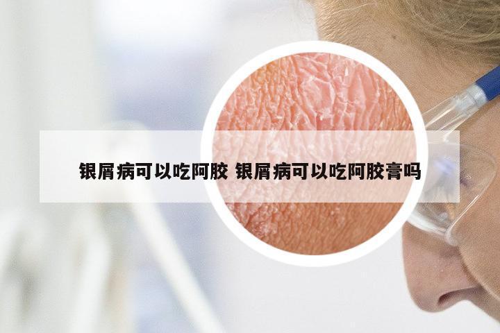 银屑病可以吃阿胶 银屑病可以吃阿胶膏吗