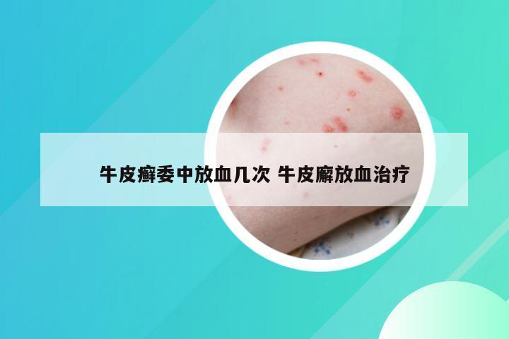 牛皮癣委中放血几次 牛皮廨放血治疗