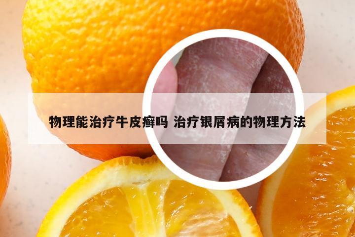 物理能治疗牛皮癣吗 治疗银屑病的物理方法