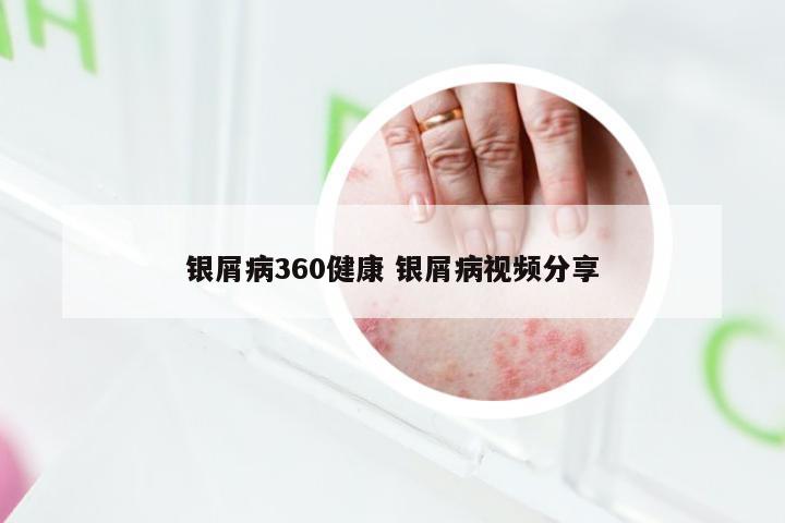 银屑病360健康 银屑病视频分享