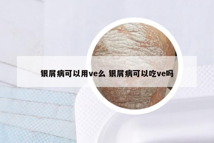 银屑病可以用ve么 银屑病可以吃ve吗