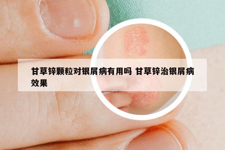 甘草锌颗粒对银屑病有用吗 甘草锌治银屑病效果