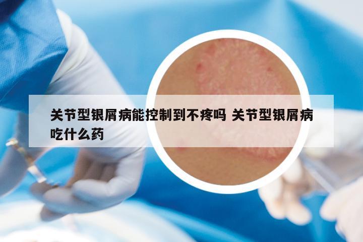 关节型银屑病能控制到不疼吗 关节型银屑病吃什么药