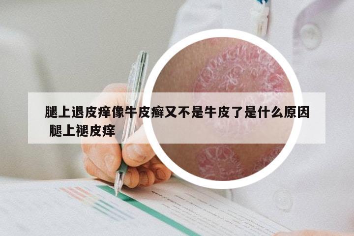 腿上退皮痒像牛皮癣又不是牛皮了是什么原因 腿上褪皮痒