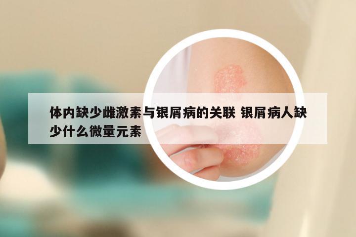 体内缺少雌激素与银屑病的关联 银屑病人缺少什么微量元素