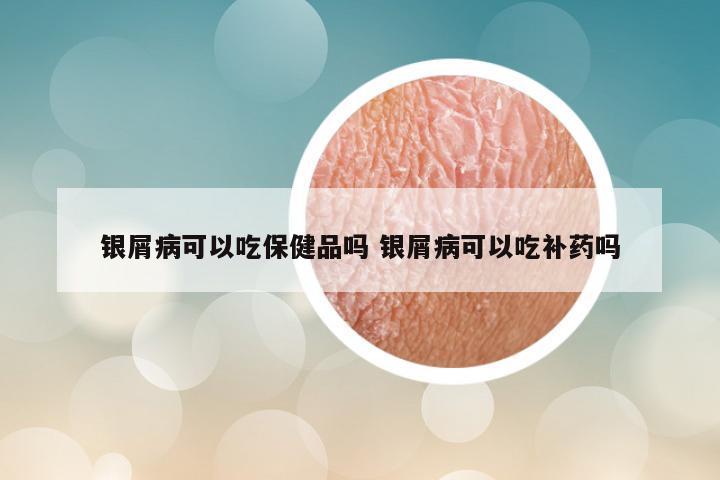 银屑病可以吃保健品吗 银屑病可以吃补药吗