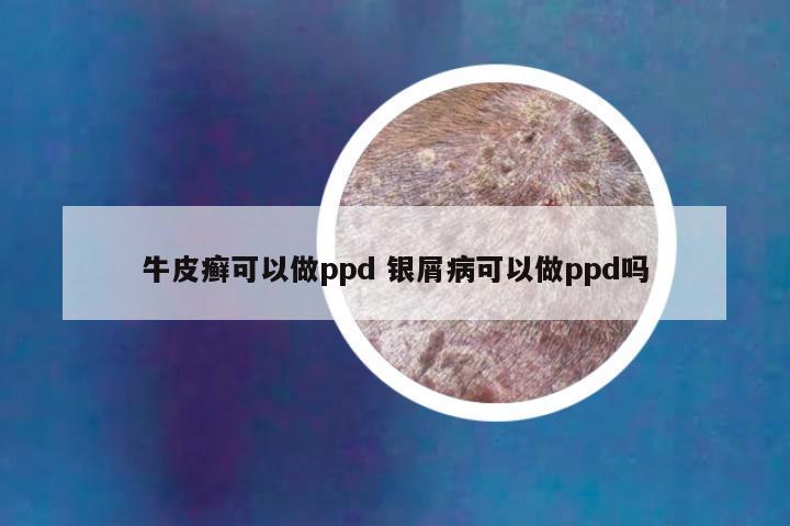 牛皮癣可以做ppd 银屑病可以做ppd吗