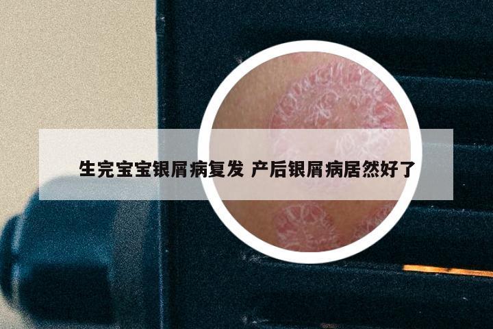 生完宝宝银屑病复发 产后银屑病居然好了