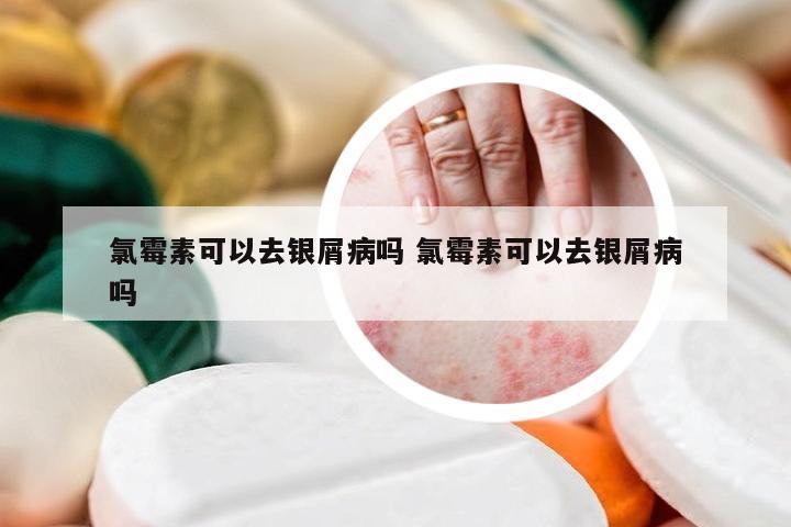 氯霉素可以去银屑病吗 氯霉素可以去银屑病吗