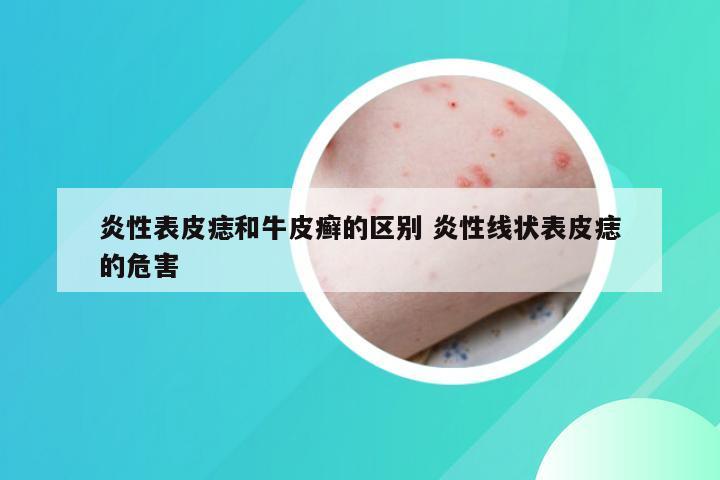 炎性表皮痣和牛皮癣的区别 炎性线状表皮痣的危害