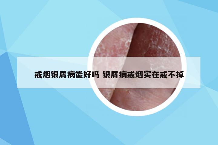 戒烟银屑病能好吗 银屑病戒烟实在戒不掉