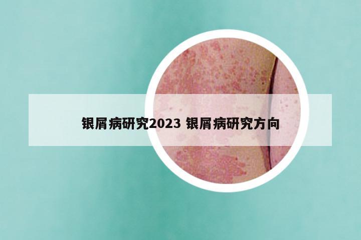 银屑病研究2023 银屑病研究方向