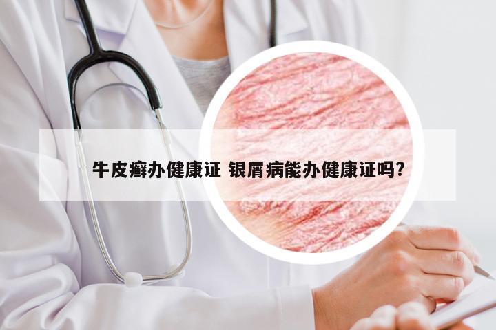 牛皮癣办健康证 银屑病能办健康证吗?