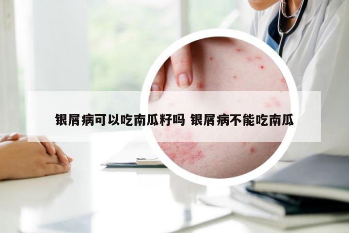 银屑病可以吃南瓜籽吗 银屑病不能吃南瓜