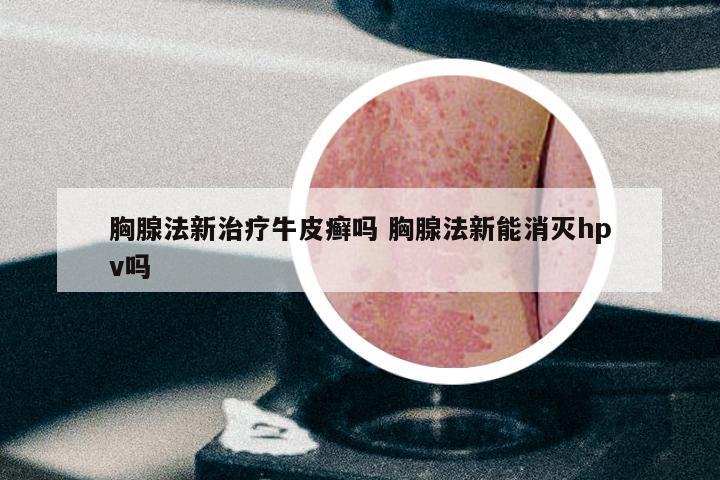 胸腺法新治疗牛皮癣吗 胸腺法新能消灭hpv吗