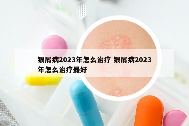 银屑病2023年怎么治疗 银屑病2023年怎么治疗最好