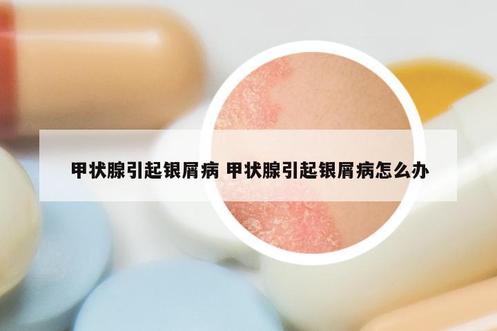 甲状腺引起银屑病 甲状腺引起银屑病怎么办