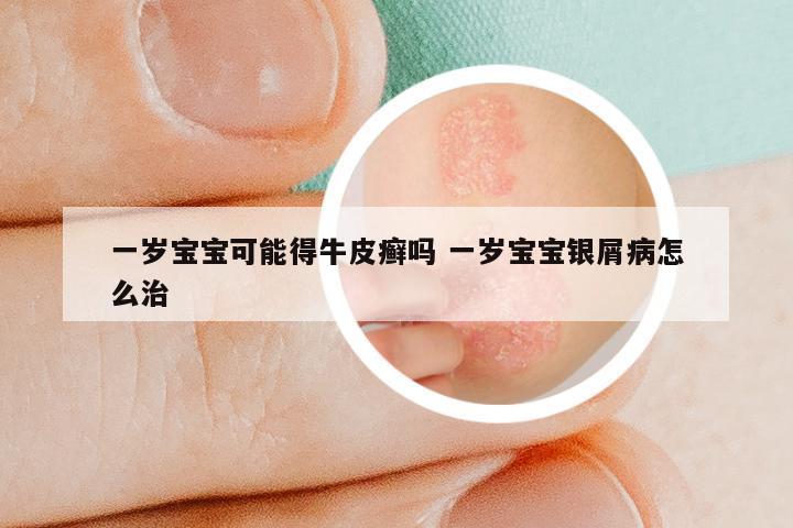 一岁宝宝可能得牛皮癣吗 一岁宝宝银屑病怎么治