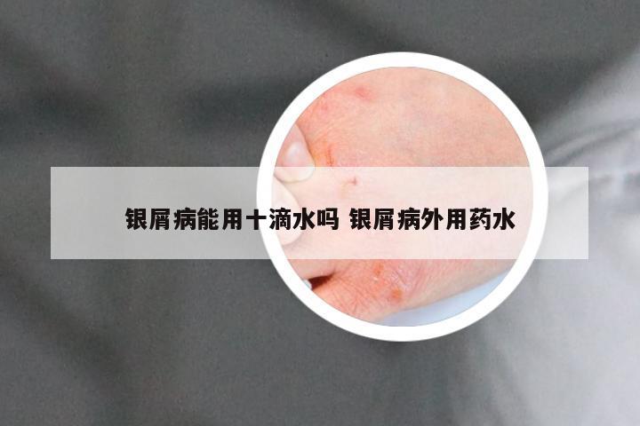 银屑病能用十滴水吗 银屑病外用药水