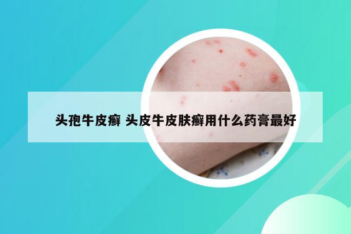 头孢牛皮癣 头皮牛皮肤癣用什么药膏最好