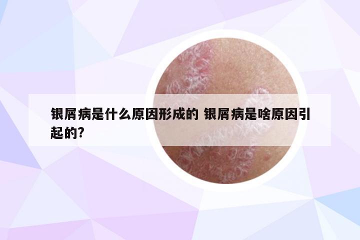 银屑病是什么原因形成的 银屑病是啥原因引起的?