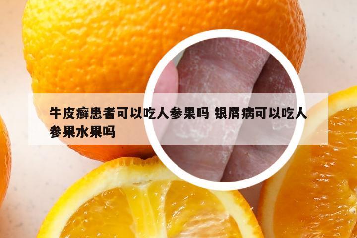 牛皮癣患者可以吃人参果吗 银屑病可以吃人参果水果吗