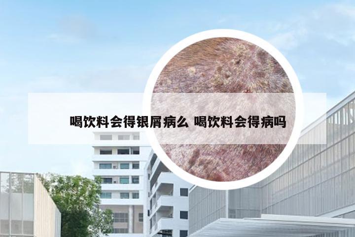 喝饮料会得银屑病么 喝饮料会得病吗