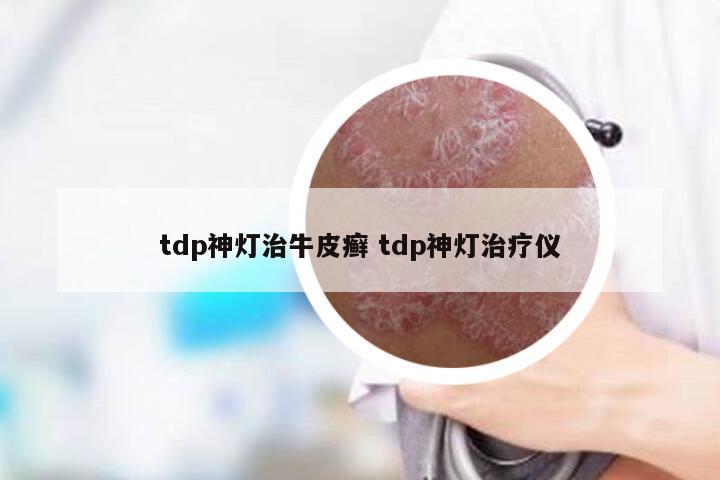 tdp神灯治牛皮癣 tdp神灯治疗仪