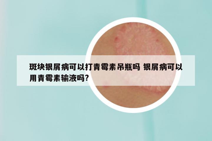 斑块银屑病可以打青霉素吊瓶吗 银屑病可以用青霉素输液吗?