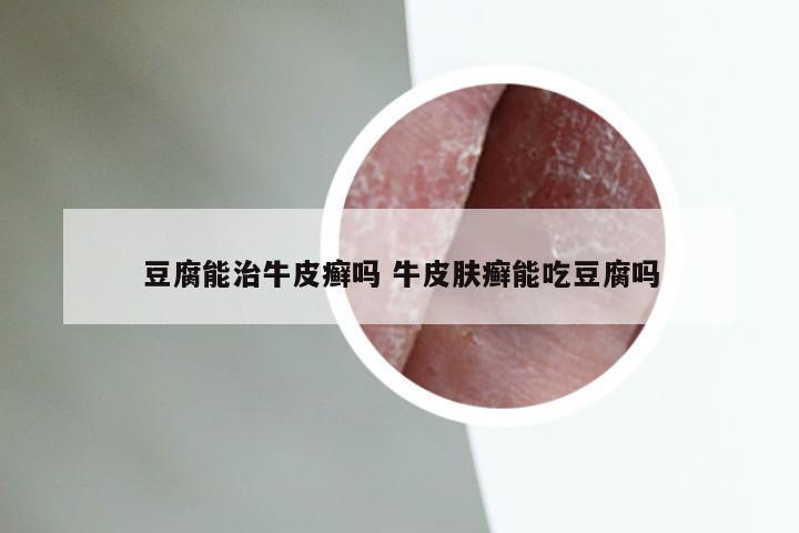 豆腐能治牛皮癣吗 牛皮肤癣能吃豆腐吗