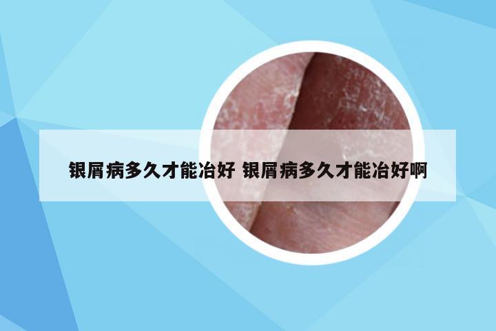 银屑病多久才能冶好 银屑病多久才能冶好啊