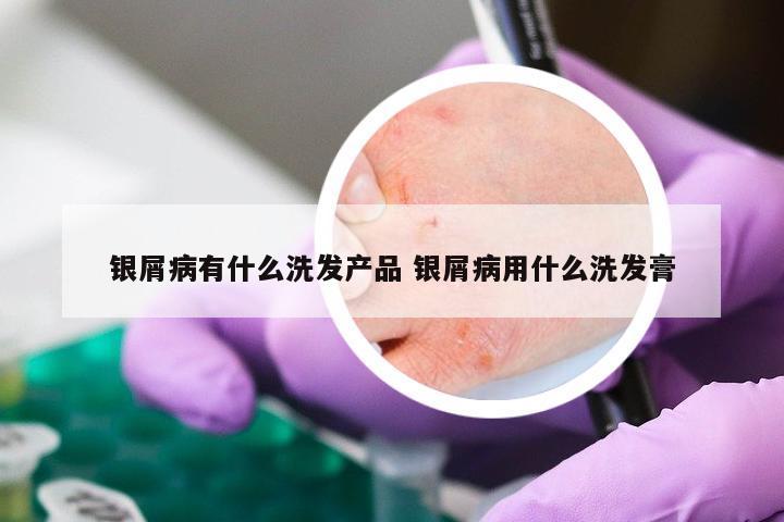 银屑病有什么洗发产品 银屑病用什么洗发膏