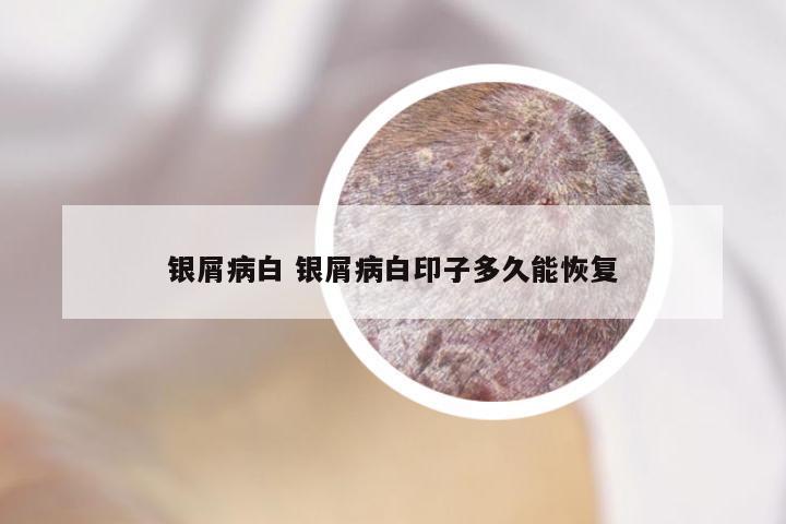 银屑病白 银屑病白印子多久能恢复