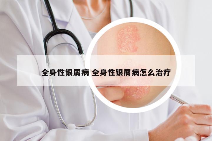 全身性银屑病 全身性银屑病怎么治疗