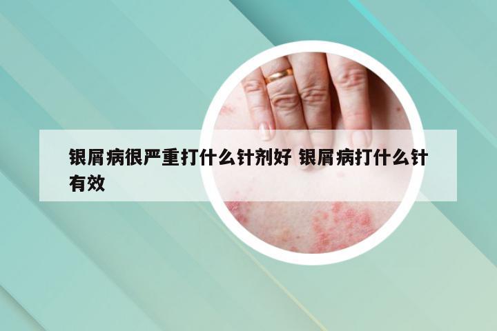 银屑病很严重打什么针剂好 银屑病打什么针有效