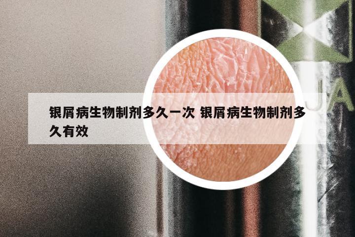 银屑病生物制剂多久一次 银屑病生物制剂多久有效