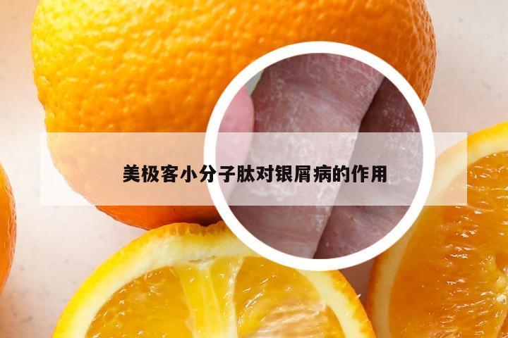 美极客小分子肽对银屑病的作用