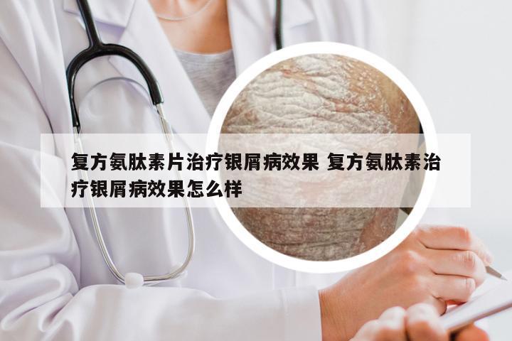 复方氨肽素片治疗银屑病效果 复方氨肽素治疗银屑病效果怎么样