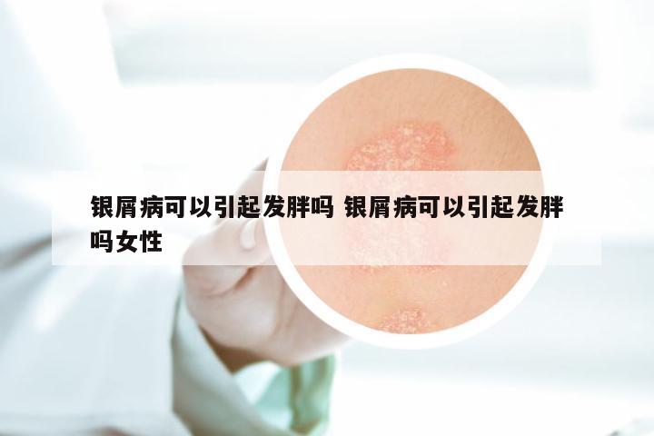 银屑病可以引起发胖吗 银屑病可以引起发胖吗女性