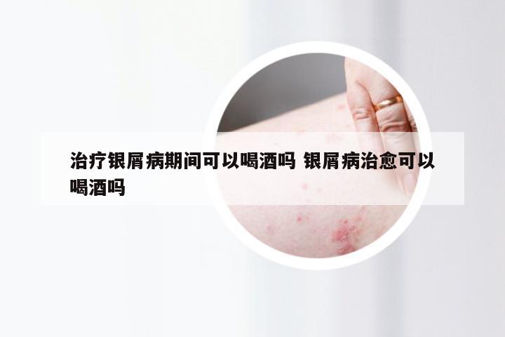 治疗银屑病期间可以喝酒吗 银屑病治愈可以喝酒吗